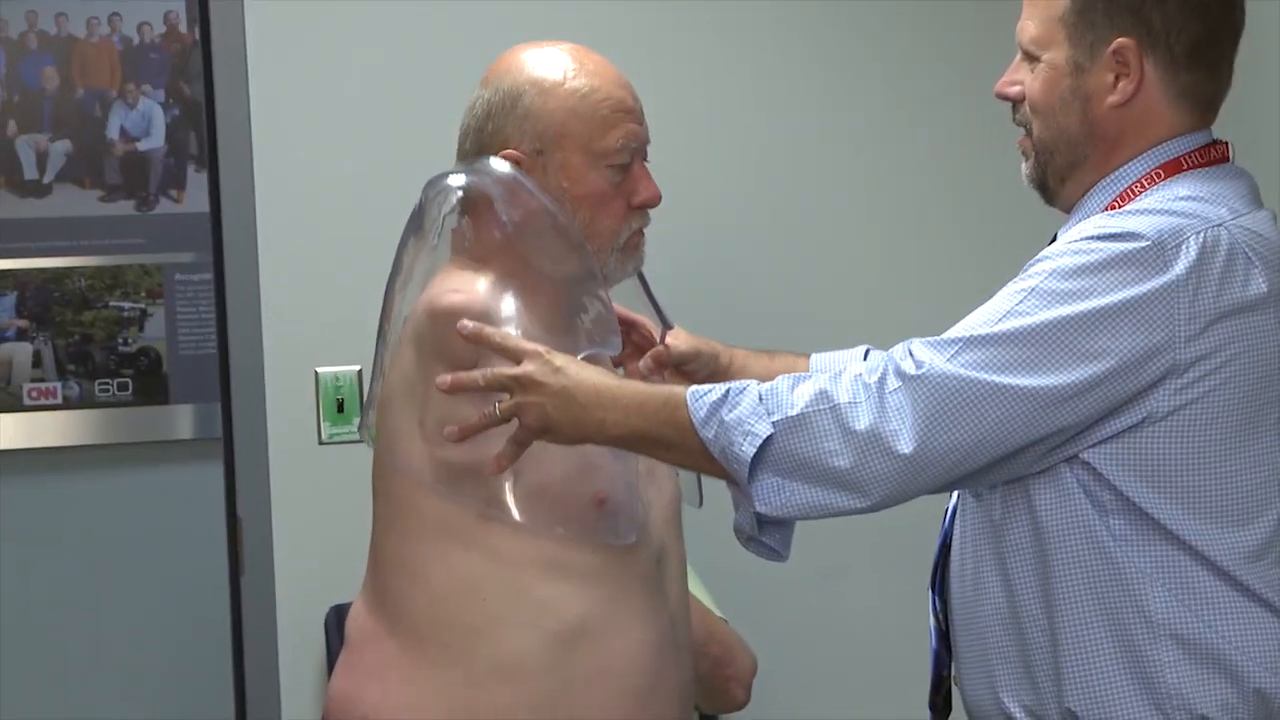 Clinicians fit a transparent plastic test socket over the patient's shoulder and torso. -