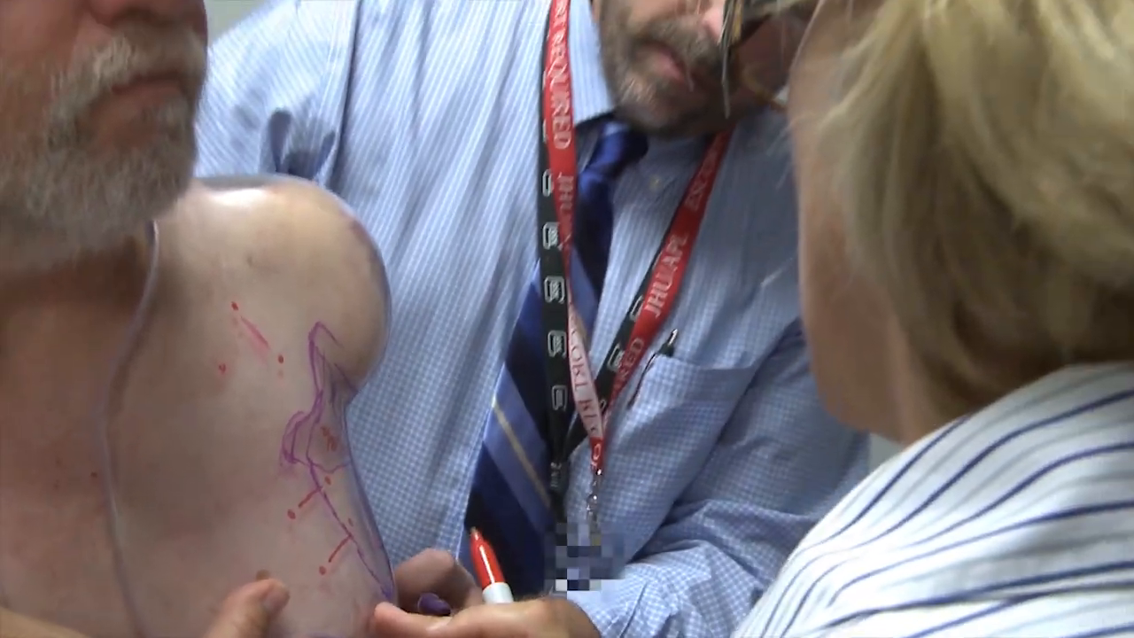 A medical professional uses a red marker to draw adjustment lines on the patient's skin and the test socket. -